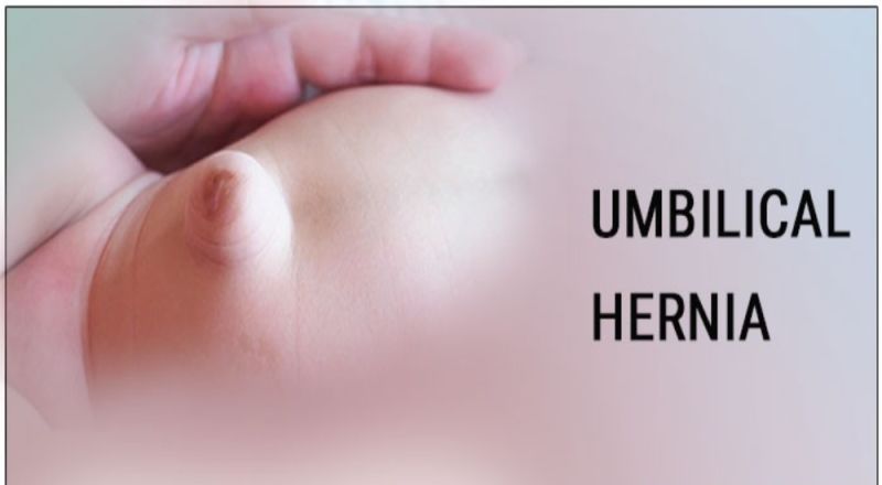 Umbilical Hernia