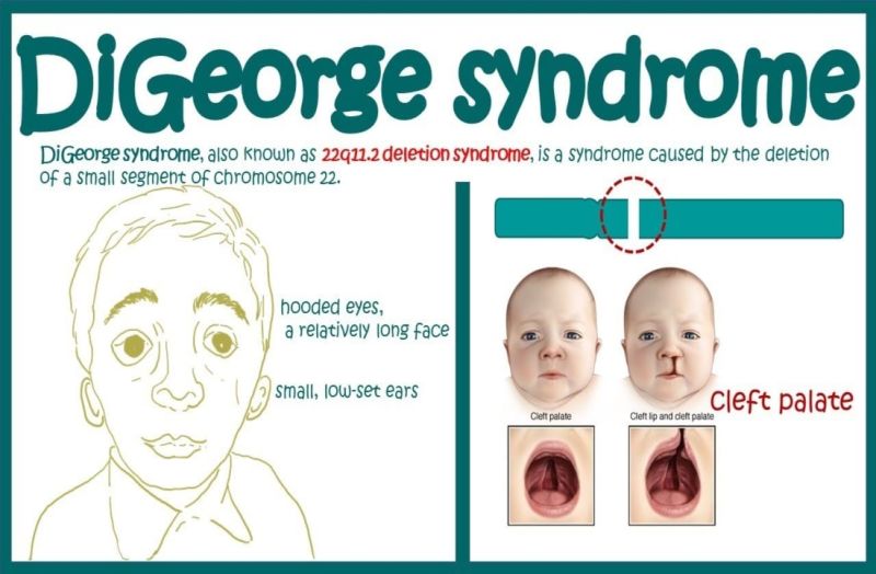 Microdeletion Syndromes