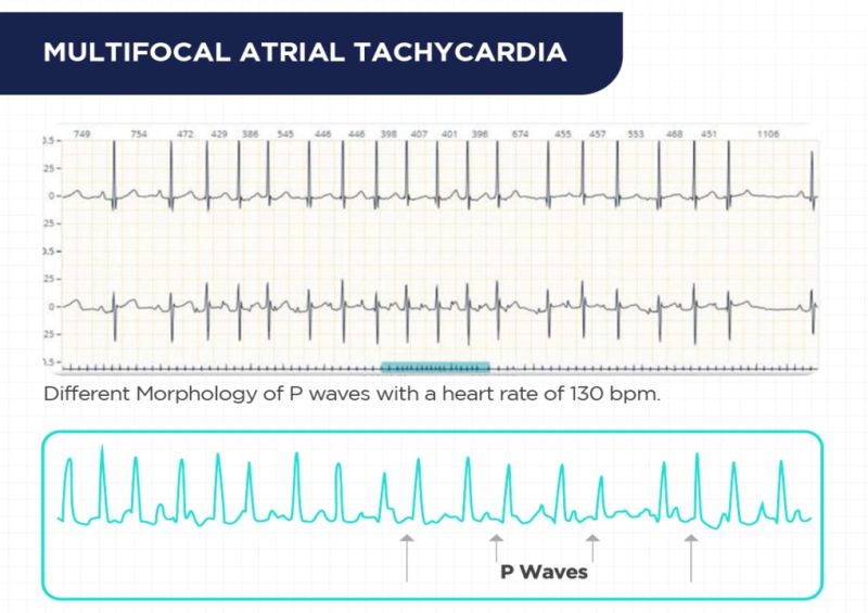 Atrial Tachycardia