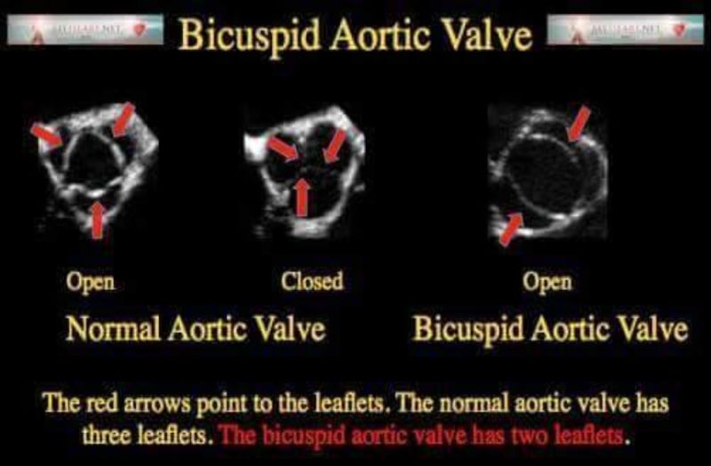 Congenital Aortic Stenosis and Bicuspid Aortic Valve