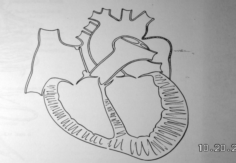 Coarctation of the Aorta