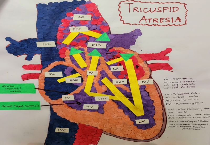 Tricuspid Atresia