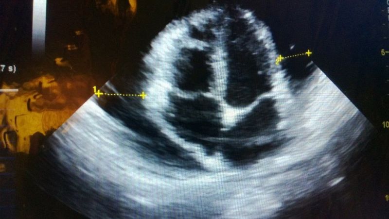 Pericardial Effusion