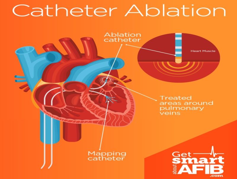 Catheter Ablation (Cardiac Ablation)
