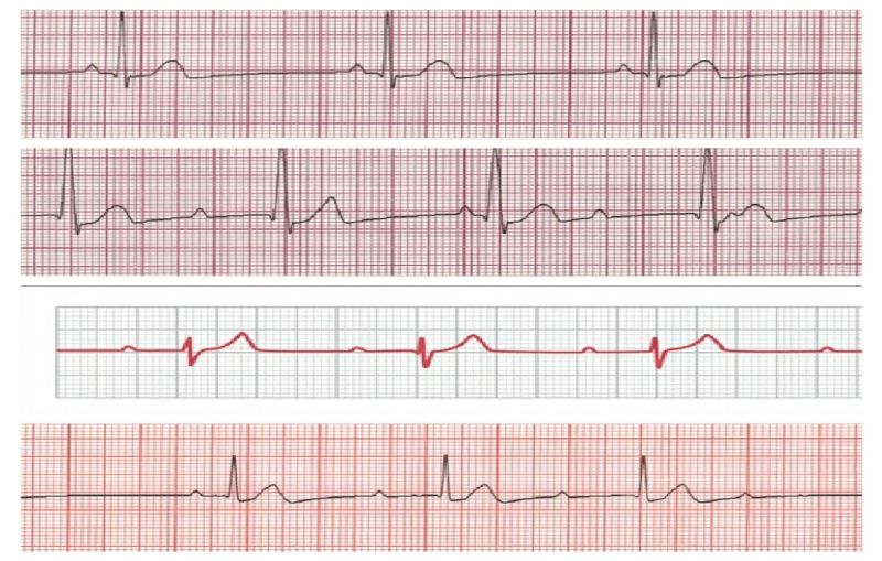 Bradyarrhythmias
