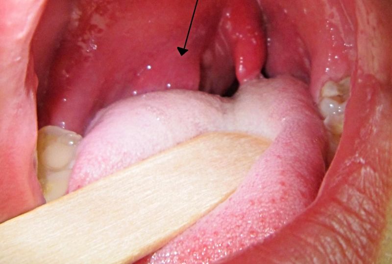 Peritonsillar Abscess