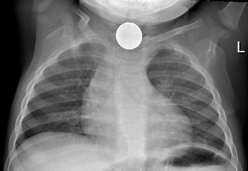 Esophageal Foreign Bodies