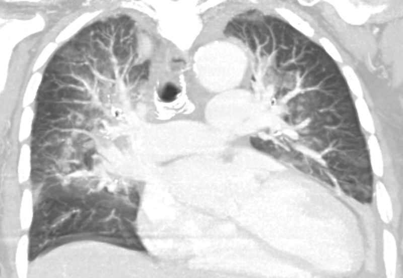 Pulmonary Edema