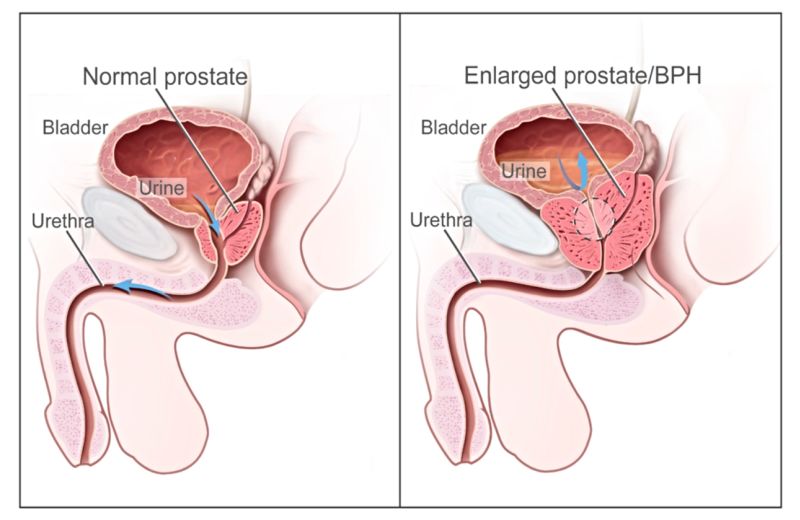 Acute Urinary Retention