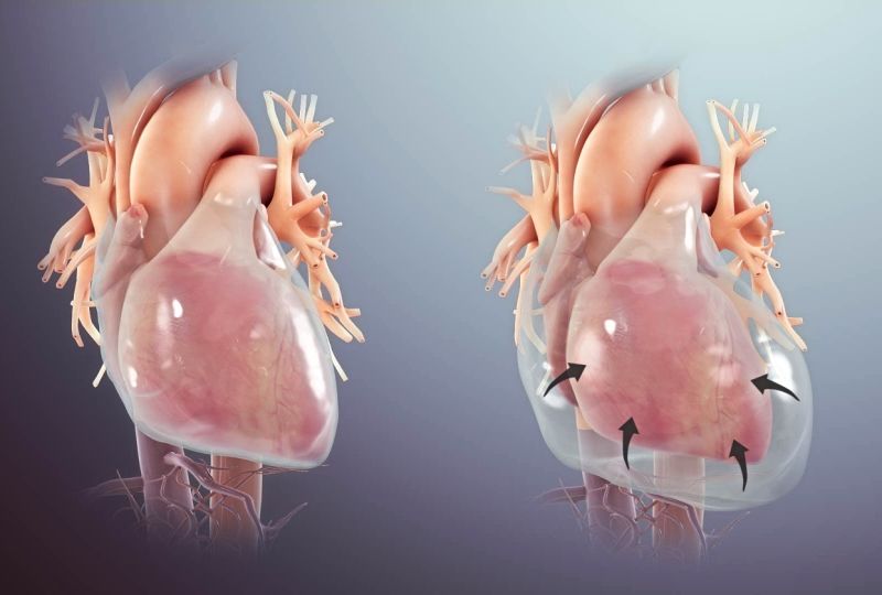 Cardiac Tamponade