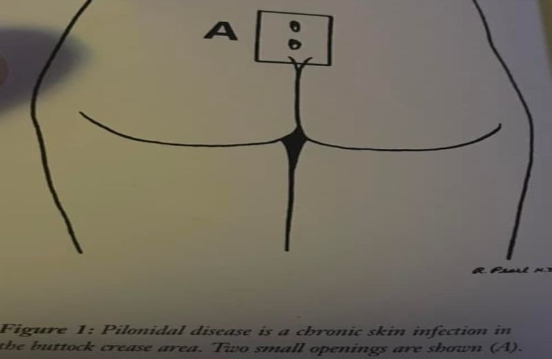 Pilonidal Sinus Disease