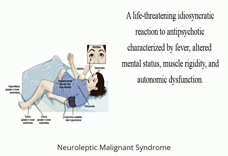 Neuroleptic Malignant Syndrome