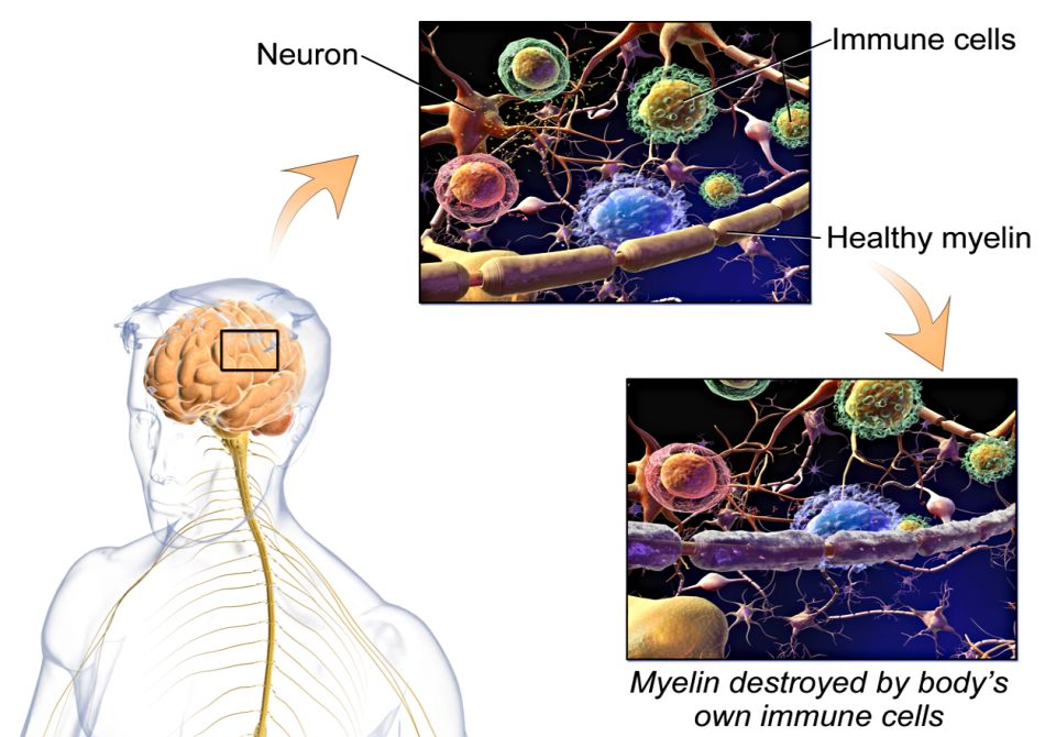 Multiple Sclerosis: Could This Be The Cure?