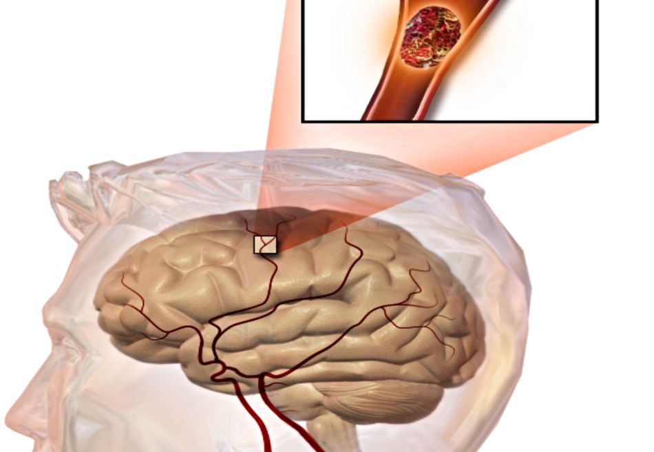 Stroke - Can We Turn It Around?