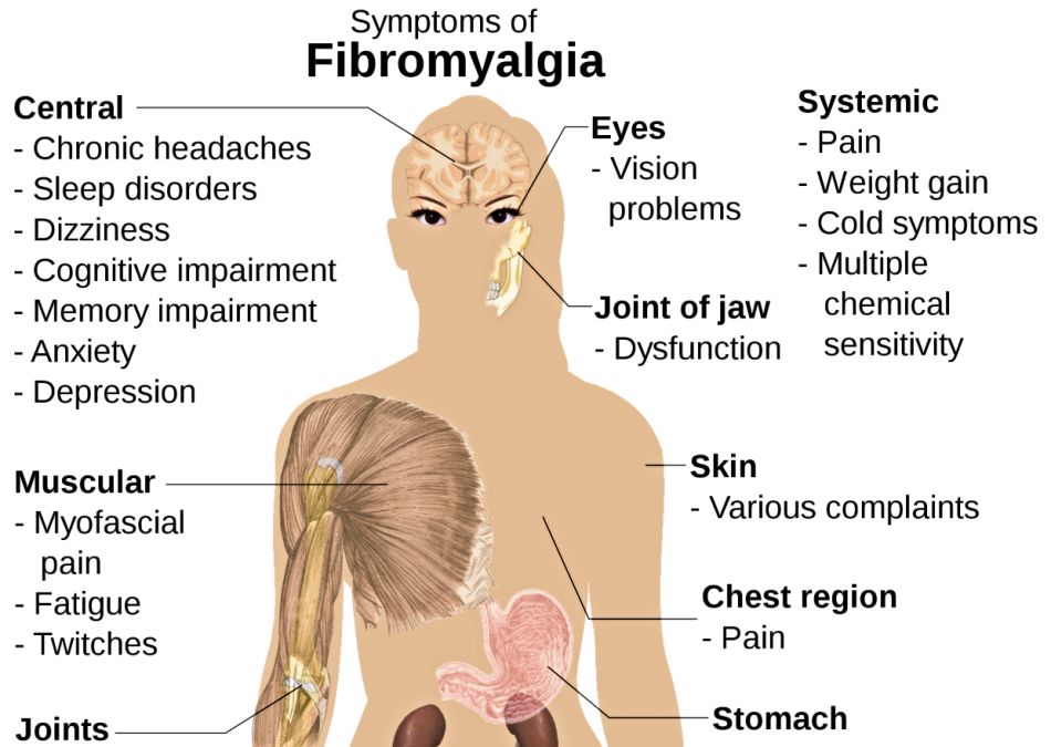 Fibromyalgia - Troubling for Sufferers and for Their Doctors