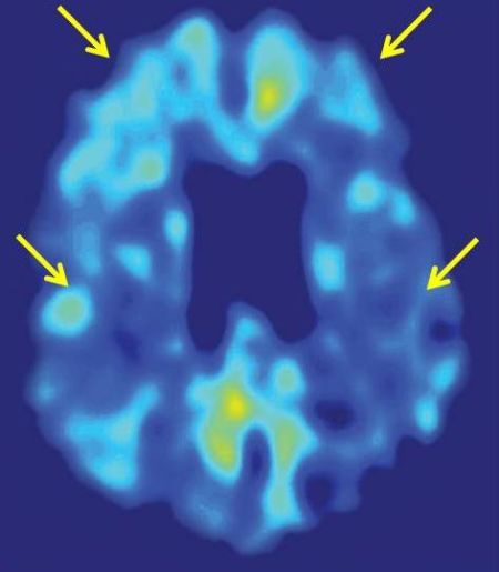 Brain Imaging Tool Plus Stroke Risk Test Help Identify Cognitive Decline Early