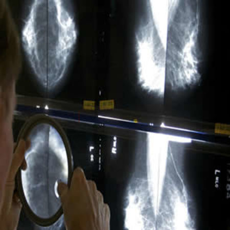 USPSTF New Mammography Guidelines Could Cost Thousands of Lives