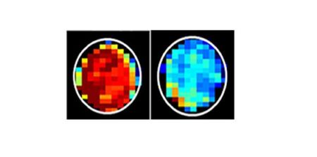 MRI Detects Cancerous Cells 