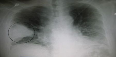 New Decision Support Tool Improves Pneumonia Care