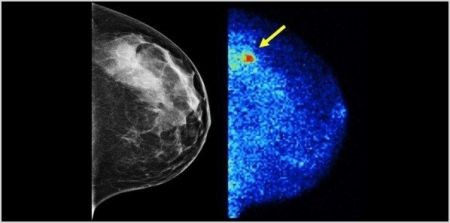 New Breast Exam Quadruples Breast Cancer Detection