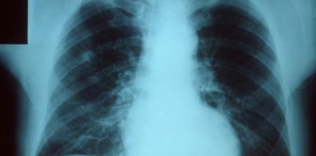 Pneumonia Hospitalisation Linked To Increased Risk of CVD