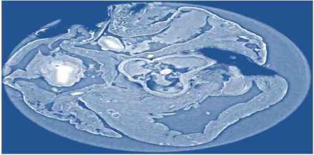 X-Ray Phase Tomography Enhanced with Synchrotron Radiation