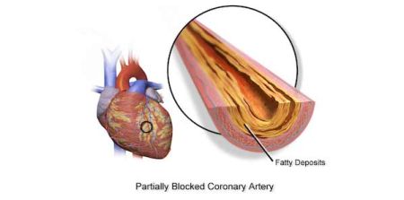 Severe Calcification Ups Risk of Cardiovascular Event