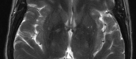 RSNA 2013: Brain Differences in Preterm Infants Highlighted via MR Spectroscopy 