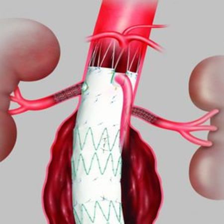 New Minimally Invasive Procedure for Abdominal Aortic Aneurysms