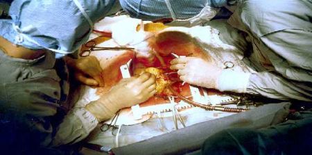 Paediatric and Congenital Heart Surgery Outcomes Now Online