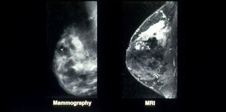 3-Minute Breast MRI &#039;Better than Mammography&#039;