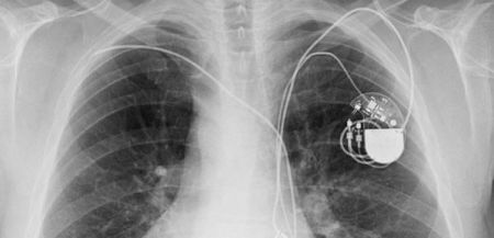 Study: Defibrillator Testing Prior to ICD Procedure Unnecessary