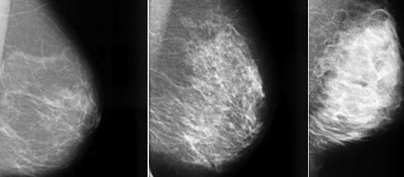 Breast Tissue Density Irrelevant for Molecular Imaging