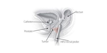 FDA Panel Disapproves Of HIFU For Prostate Cancer 