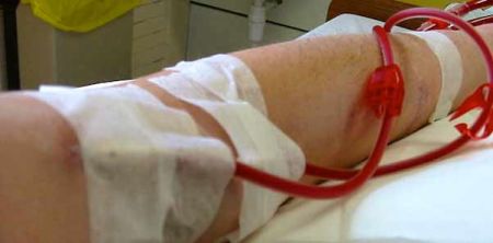 Antibiotic Therapy Benefits Haemodialysis Patients