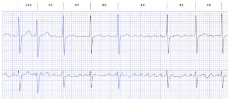 New Atrial Fibrillation Treatment Device