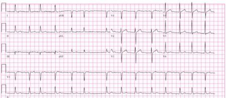 Atrial Fibrillation Seemingly Connected to Heart Attack Risk