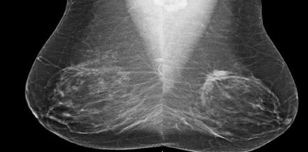 #RSNA14: Risk-Based Screening Misses Breast Cancers in Women in Their 40s