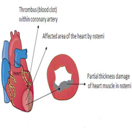 Atrial Fibrillation Increases Risk of NSTEMI