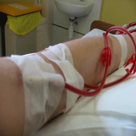 New Test Can Predict Sudden Cardiac Death in Haemodialysis Patients