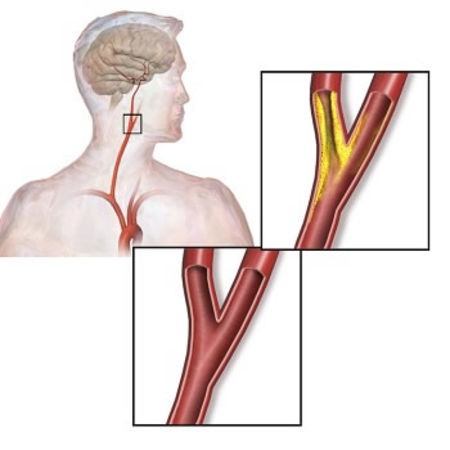 Variation in Carotid Artery Stenting Outcomes
