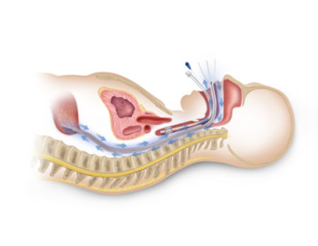 Advanced Cooling Therapy Receives FDA Clearance for Esophageal Cooling Device