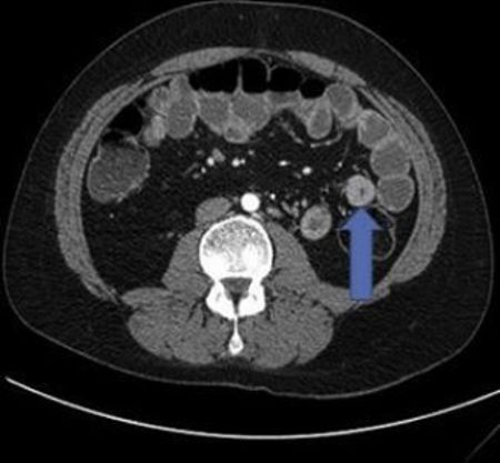 thickening of the small bowel as seen in Crohn disease