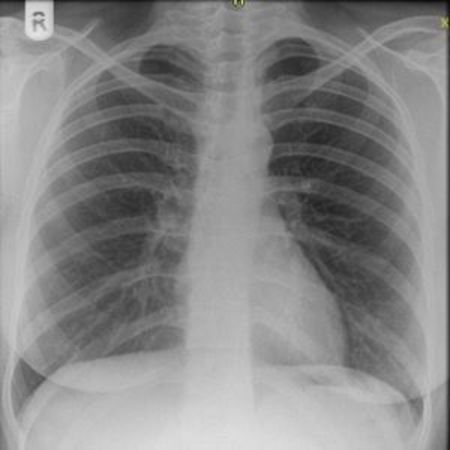 chest x-ray close-up