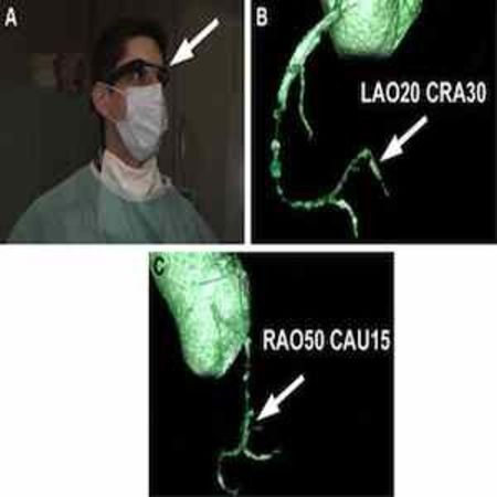 CTA images displayed in Google Glass. (A) Cardiologist viewing the CTA images in the upper right visual field on Google Glass (Google Inc, Mountain View, CA) (arrow) during a CTO recanalization attempt. (B, C) Three-dimensional reconstructions projected d