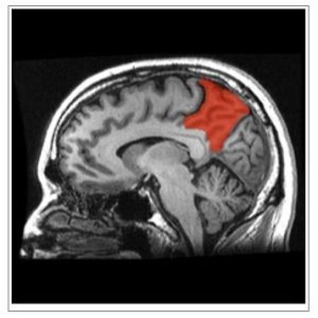 sagittal MRI slice with the precuneus shown in red