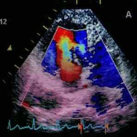 Metabolic enzyme may offer new approach to treat early heart failure