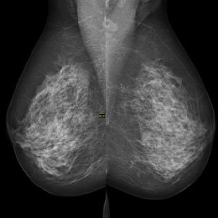 Digital Mammography Helps Predict Heart Disease
