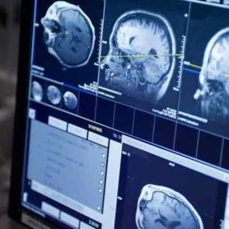 Radiation-Chemo Combo Prolongs Survival in Low-Grade Brain Tumour