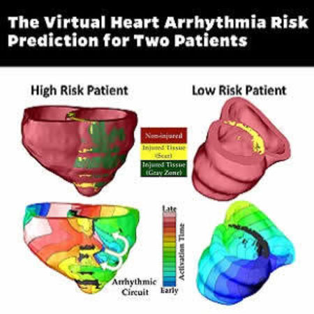 Virtual Heart Predicts Risk of Sudden Cardiac Death 